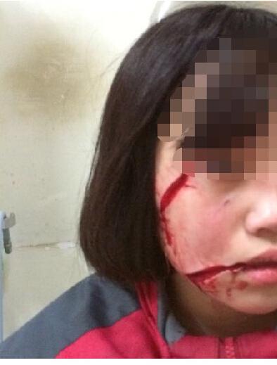 16岁女孩放学路上遭人毁容 右脸被划两刀(图)