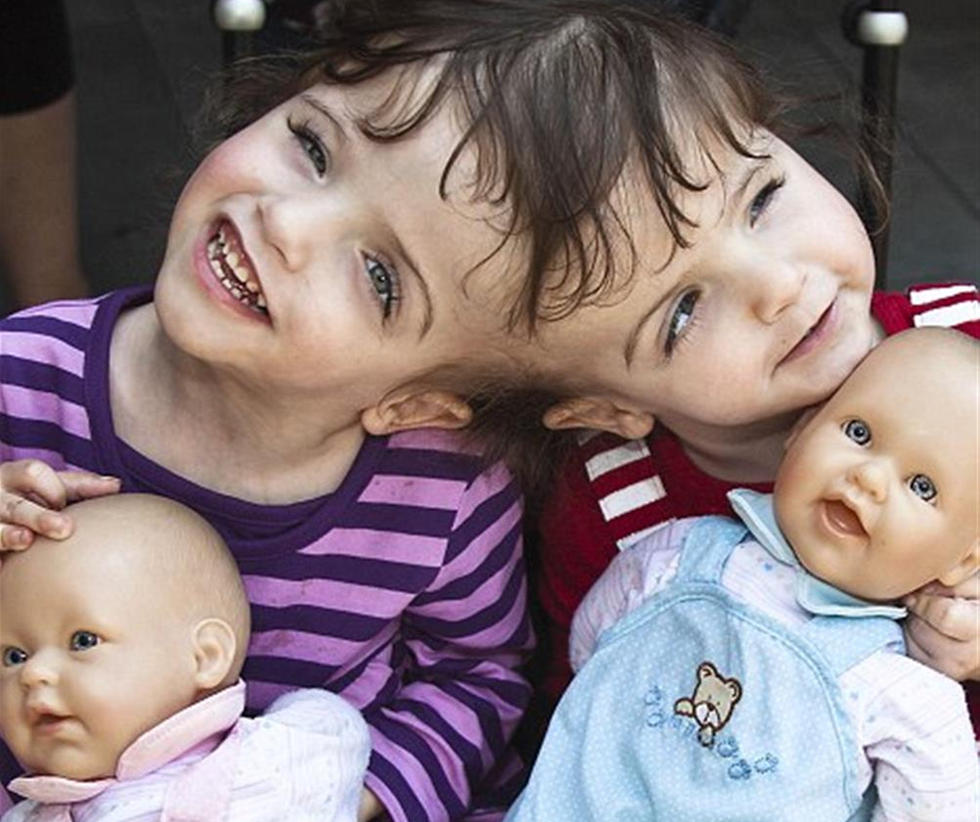 加拿大7岁连体婴姐妹共用一个大脑