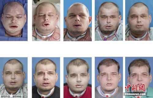 美国一名男子在“换脸手术”期间面部的变化情况。